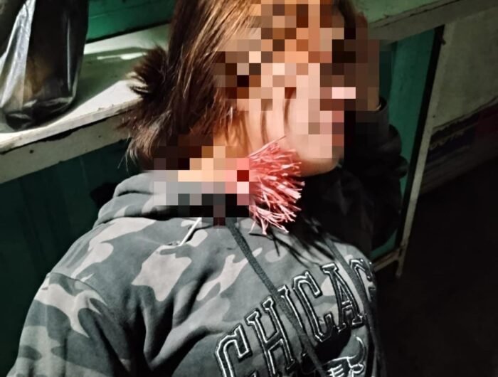 Korban pembusuran, AM (22), mengalami luka di bagian atas dada setelah terkena anak panah di Jalan Haji Kalla, kawasan Panaikang, Makassar, Rabu (14/10/2026).
